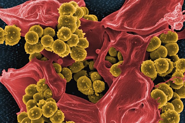 Leucémie : les méthodes essentielles pour un diagnostic précoce et fiable